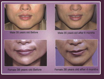 botox in goa india , BOTOX INJECTIONS, dermal fillers, sergial facial lifts