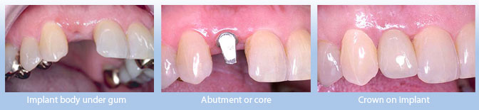 implant body under gum, abutent or core, crown on implant