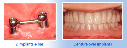 implant plus bars, dentures over implants