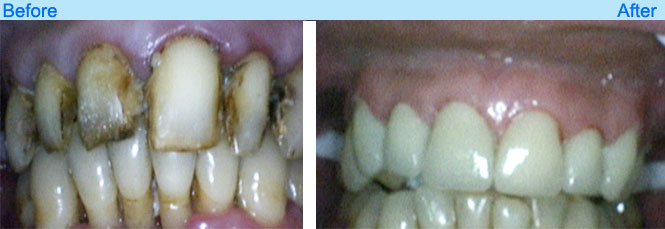 world class dental services like metal free crown in goa